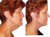 Rhinoplasty, closed technique with osteotomies