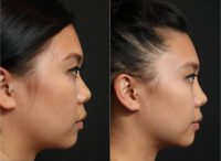 18-24 year old woman treated with Non Surgical Nose Job