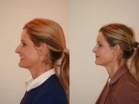 45 year old woman treated with Rhinoplasty