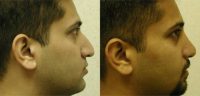 Rhinoplasty - 25 year old male, 3 months post-op