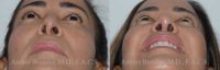 31 year old woman treated with Revision Rhinoplasty