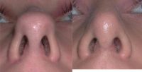 25-34 year old man treated with Rhinoplasty