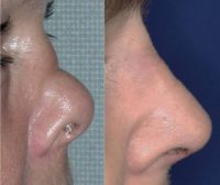 35-44 year old woman treated with Rhinoplasty