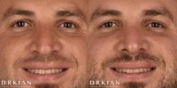 Revision Rhinoplasty Before & After Seven Weeks, performed by Dr. Kian Karimi