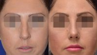 Woman treated with Rhinoplasty