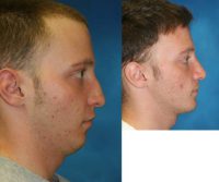 Young man with Rhinoplasty and chin implant