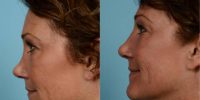 45-54 year old woman treated with Revision Rhinoplasty/Septal Perforation