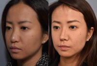 35-44-year-old woman treated with Asian Revision Rhinoplasty