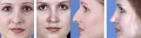Rhinoplasty front and side profile of bridge of nose