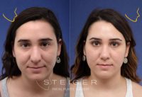 23 year old woman treated with Rhinoplasty