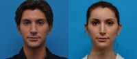 25-34 year old man treated with Facial Feminization Surgery