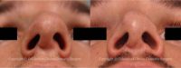 18-24 year old man treated with Revision Rhinoplasty