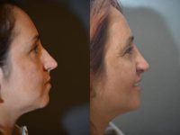 38 year old woman treated with Rhinoplasty