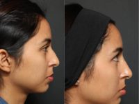 18-24 year old woman treated with Non Surgical Nose Job