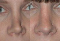 18-24 year old woman treated with Revision Rhinoplasty