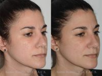 32 year old woman treated with Revision Rhinoplasty