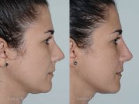 32 year old woman treated with Revision Rhinoplasty