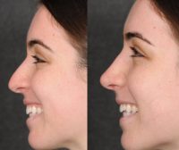 18-24 year old woman treated with Rhinoplasty (Closed)