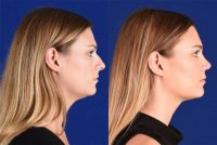 25 year old woman treated with Rhinoplasty