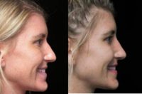 18-24 year old woman treated with closed scarless Rhinoplasty