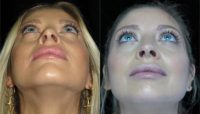 18-24 year old woman treated with CLOSED SCARLESS NOSE Rhinoplasty only 2 weeks post-op.
