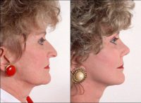 Rhinoplasty and Face Lift