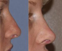 25-34 year old woman treated with Rhinoplasty