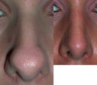 25-34 year old woman treated with Rhinoplasty