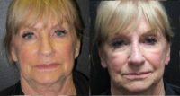 55-64 year old woman treated with Non Surgical Nose Job