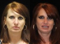 45-54 year old woman treated with Rhinoplasty