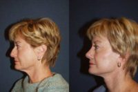 Female with Rhinoplasty and Facelift