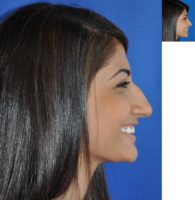 Teenage Rhinoplasty Before and Afters