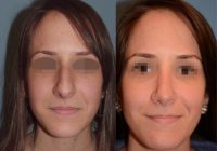 18-24 year old woman treated with Rhinoplasty & Sinus Surgery for a Deviated Septum