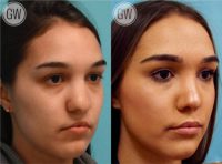 18-24 year old woman treated with Revision Rhinoplasty - Cleft rhinoplasty and lip fat grafting