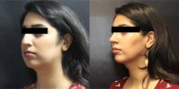 18-24 year old woman treated with Rhinoplasty