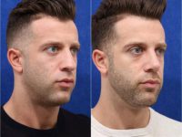 25-34 year old man treated with Rhinoplasty