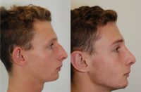 18-24 year old man treated with Rhinoplasty