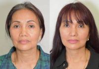 55-64 year old woman treated with Deep Plane Facelift