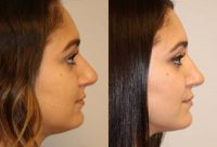 24 year old woman treated with Rhinoplasty