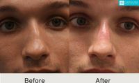 25-34 year old man treated with Nonsurgical Nose Job