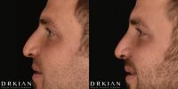 Revision Rhinoplasty Before & After Seven Weeks, performed by Dr. Kian Karimi