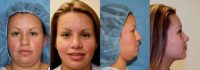 Rhinoplasty, neck liposuction, chin augmentation