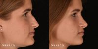 Teen Rhinoplasty Before & After One Year by Dr. Kian Karimi