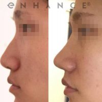 Woman treated with Rhinoplasty