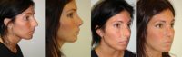 20 Year Old Female Rhinoplasty Before and After