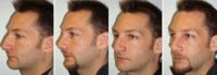 35 Year Old Male Before and After Rhinoplasty