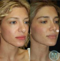 25-34 year old woman treated with Facial Fat Transfer