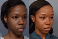 25-34 year old woman treated with African American Rhinoplasty & Septoplasty