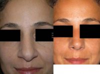 37 year old woman treated with Septoplasty
