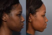 25-34-year-old woman treated with African American Rhinoplasty & Septoplasty